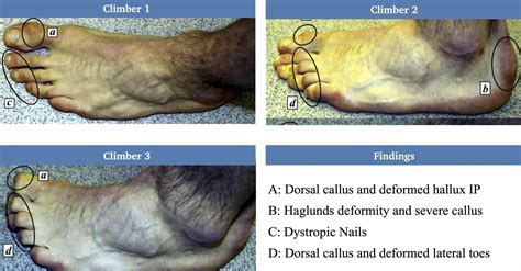 Are your climbing shoes too small? Foot and toe injuries explained - The Climbing Doctor