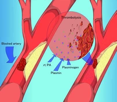 Thrombectomy Minimally Invasive Treatment For Blood Clots