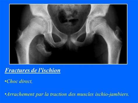 Ideen 149 Branche Ilio Pubienne Fracture Bethscrichfieldy