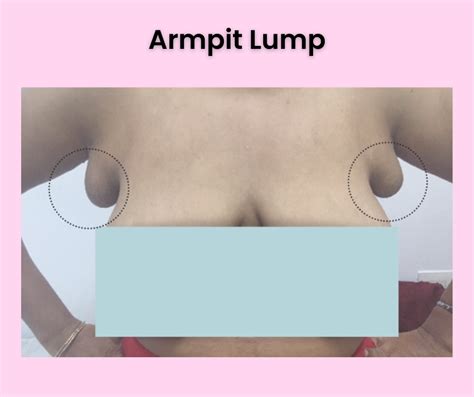 Effective Armpit Lump Treatment in Pune | Expert Care Available ...