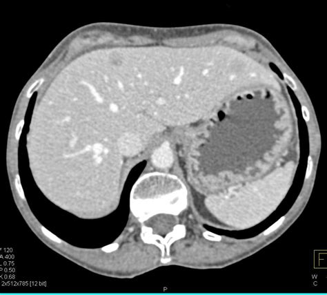 Carcinoid Tumor With Mesenteric Mass And Desmoplastic Reaction And