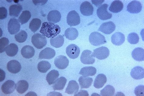 Free Picture Micrograph Two Vivax Trophozoites Fused Platelets Magnified 1125x