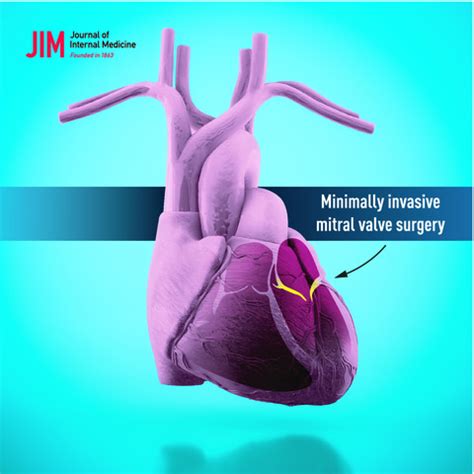 Minimally Invasive Mitral Valve Surgery Is Associated With A Low Rate