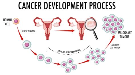 Innovative Approaches to Ovarian Cancer Treatment - EmptyLightHome