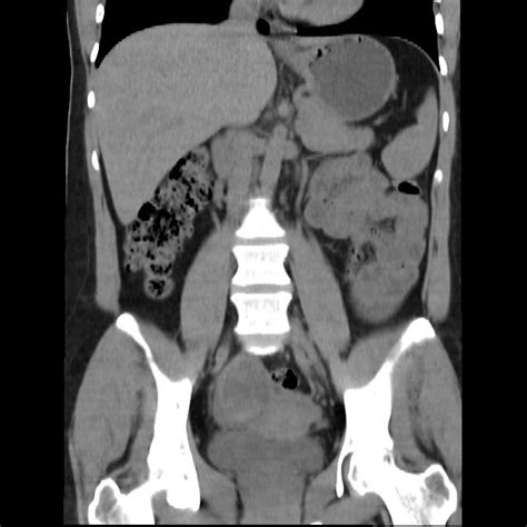 Bilateral Ovarian Dermoid Cyst Image