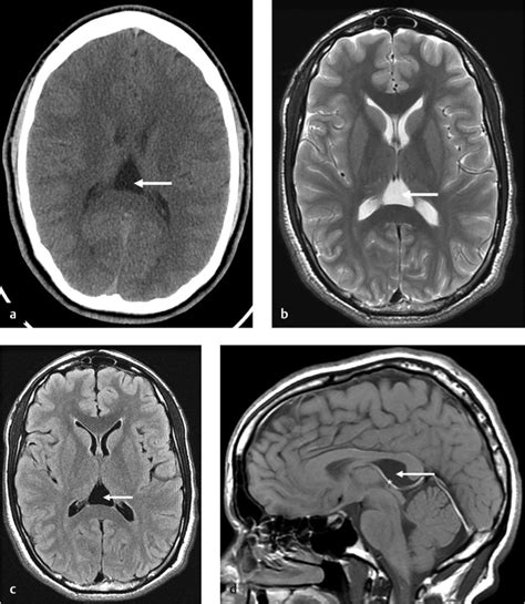 Septum Pellucidum