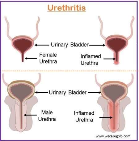 Urethritis: Causes, Signs and Symptoms, Management - We Care