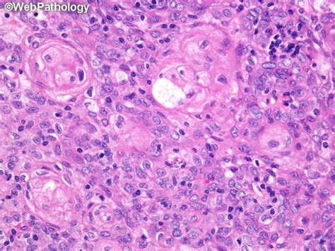 Type B3 Thymoma Prognosis