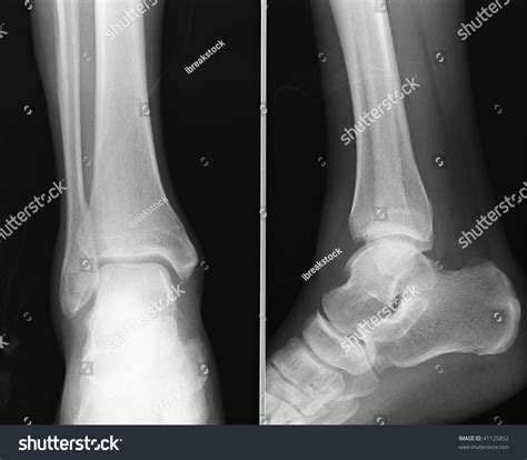 X-Ray Of A Heel Stock Photo 41125852 : Shutterstock