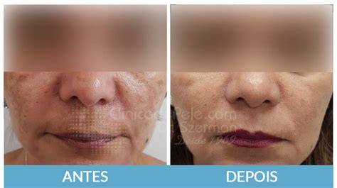 Achieve Optimal Results Post CO2 Laser Care Guide O Melhor