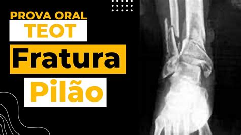 Fratura Do Pil O Tibial Youtube