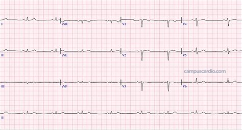 Calcula La Frecuencia Cardíaca En El Siguiente Electrocardiograma