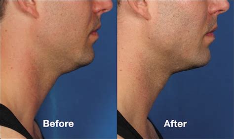 Kybella For Men Reduce A Double Chin Refine Your Jawline Kalos