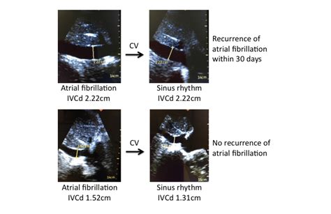 Example Measurements Of The Inferior Vena Cava By Handheld Ultrasound