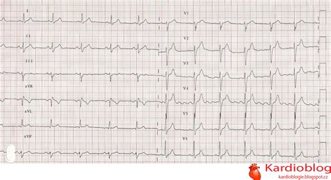 Kardioblog Ekg Kazuistika Let Pacient