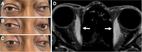 Orbital Myositis Mimicking Wall Eyed Bilateral Internuclear