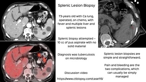 Case 115 Splenic Lesion Biopsy