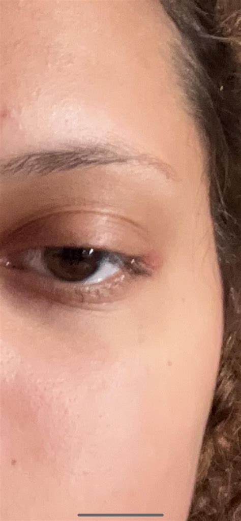 Recurring Itchy Red Bumps Around My Eye What Could It Be R Medical Advice