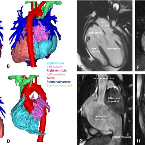 Anatomy of double inlet left ventricle patient 2. (A) Anterior view ...