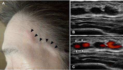 Temporal Artery Ultrasound