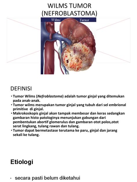 Wilms Tumor Nefroblastoma Pdf