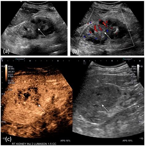 A 71-year-old-woman with right renal mass. (a) Grey-scale ultrasound... | Download Scientific ...