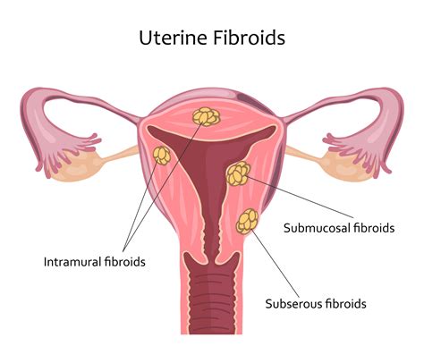 What Are Uterine Fibroids Responsum Health