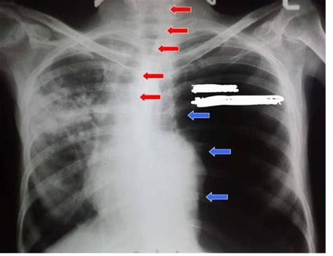 Chest X Rays Flashcards Quizlet