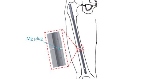 Novel Hybrid System For Fracture Fixation Innovative Degradable