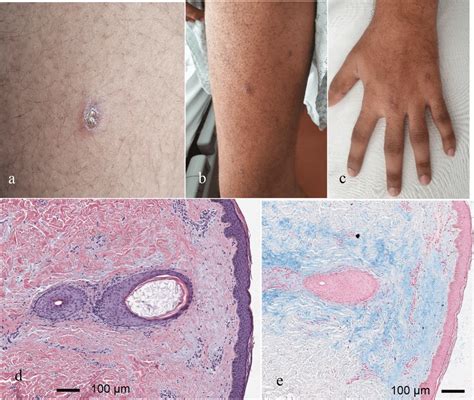 Ac Images Of Patients Skin Lesions At Week 3 Small Keratotic