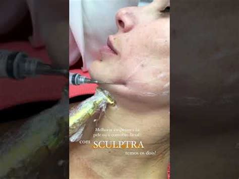 Sculptra Cido Poli L L Ctico Shorts Youtube