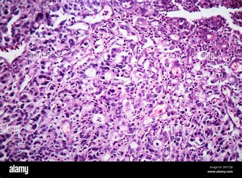 Gastric Adenocarcinoma Light Micrograph Photo Under Microscope Stock