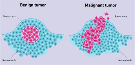 Skin Cancers Causes Diagnostic And Modern Detection Tools