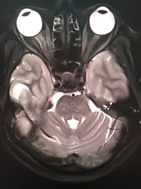 Sigmoid Right Transverse And Sigmoid Sinuses Thrombosis