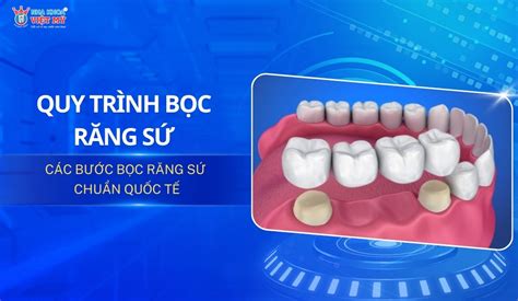 Quy trình bọc răng sứ với các bước chuẩn quốc tế