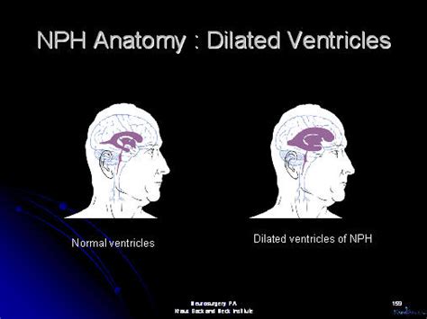 Nph Normal Pressure Hydrocephalus Hydrocephalus Vp Shunt Vp