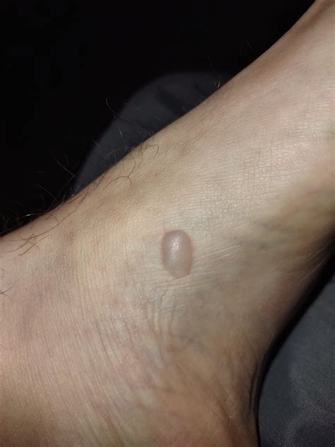 Is this a wart, cyst, or just a blister? And is it anything to worry