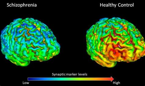 Schizophrenia patients show fewer brain connections than healthy people