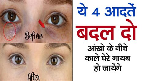 Dark Circles Kaise Hataye आखों के काले घेरे हटाने के घरेलू नुस्खे