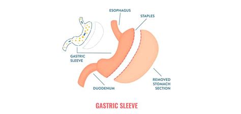 Gastric Sleeve Vs Gastric Bypass Whats The Difference Magnolia