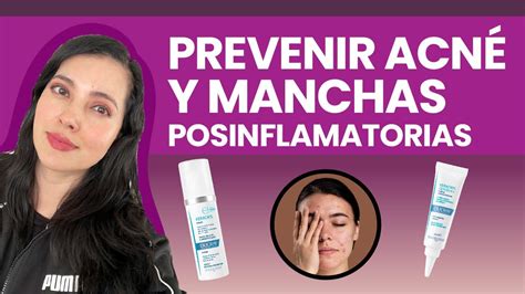 Como Mejorar Acn Y Manchas Rese A Keracnyl Glycolic Y Serum Youtube