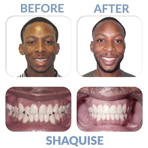 Before And Afters Miler Orthodontics Orthodontist Sc 29910