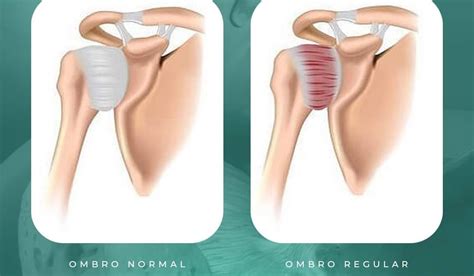 Quiropraxia Araraquara Capsulite Adesiva