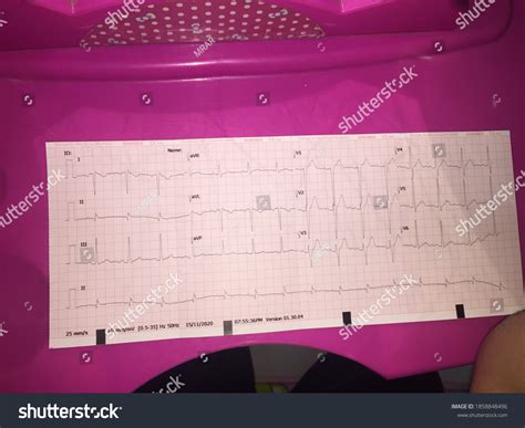 Normal Heart Graph Through Electrocardiogram Ecg Stock Photo 1858848496 ...