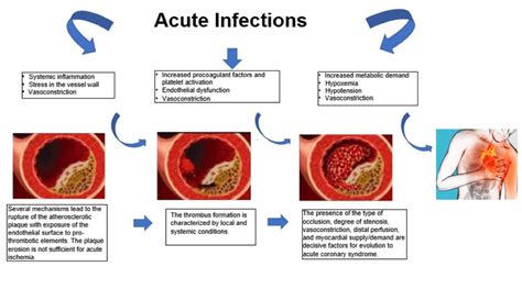 Acute Infections Triggering Myocardial Injury And Acute Coronary