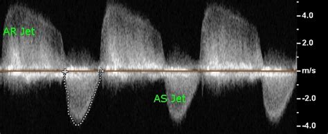 Moderate AS, AR – Continuous wave Doppler – All About Cardiovascular ...