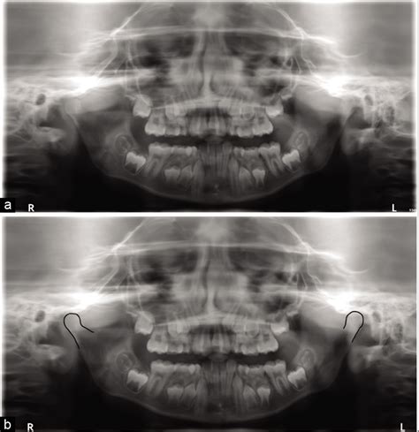 Optimal Use Of A Panoramic Radiograph As A Screening Tool For Condylar