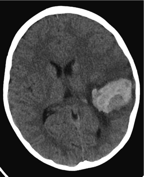 A non-contrast brain CT scan reveals a substantial region of recent ...