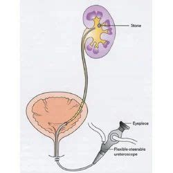 Kidney Stone Removal in Thrissur