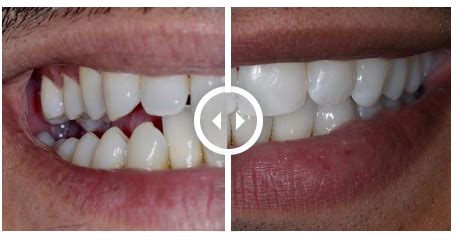 Smile Transformation: Clear Aligners Before and After | Delhi Dental